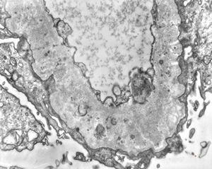 F,49y. | membranous glomerulopathy F,49y. | membranous glomerulopathy